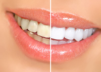 Teeth Whitening Danvers