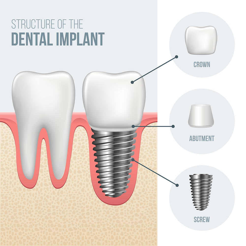 Illustration of Dental Implants structure, Danvers, MA